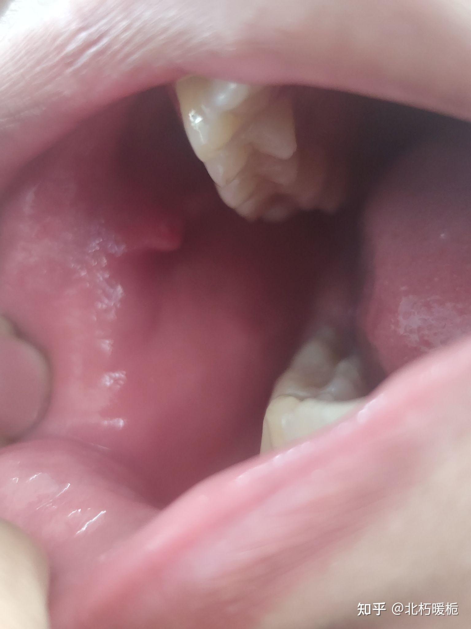 口腔里面长了肉疙瘩和小红点是什么