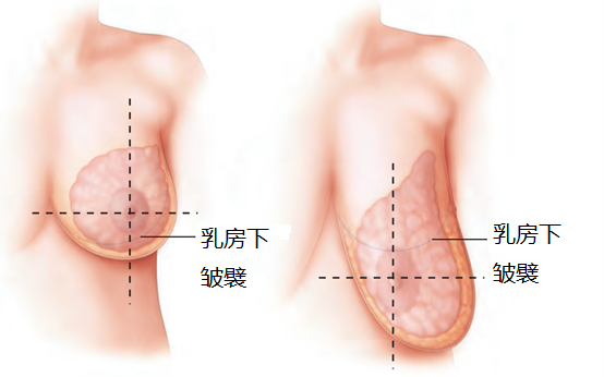 正常乳房中的大部分腺性乳房组织位于外侧