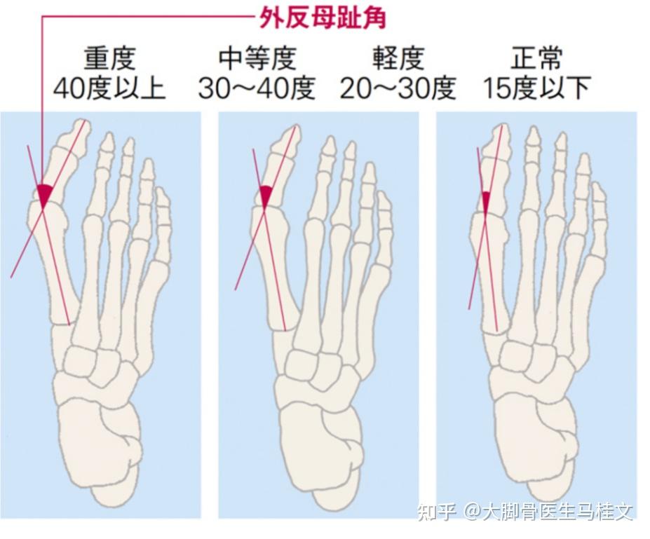 脚痛的4个部位，你该怎样应对？ - 知乎