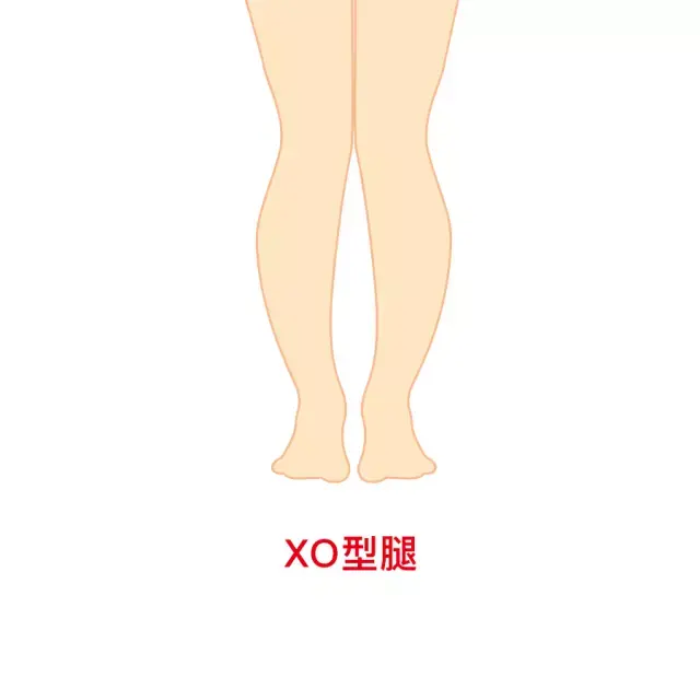 如何判断xo型腿的成因及合适的运动矫正方法？ 知乎