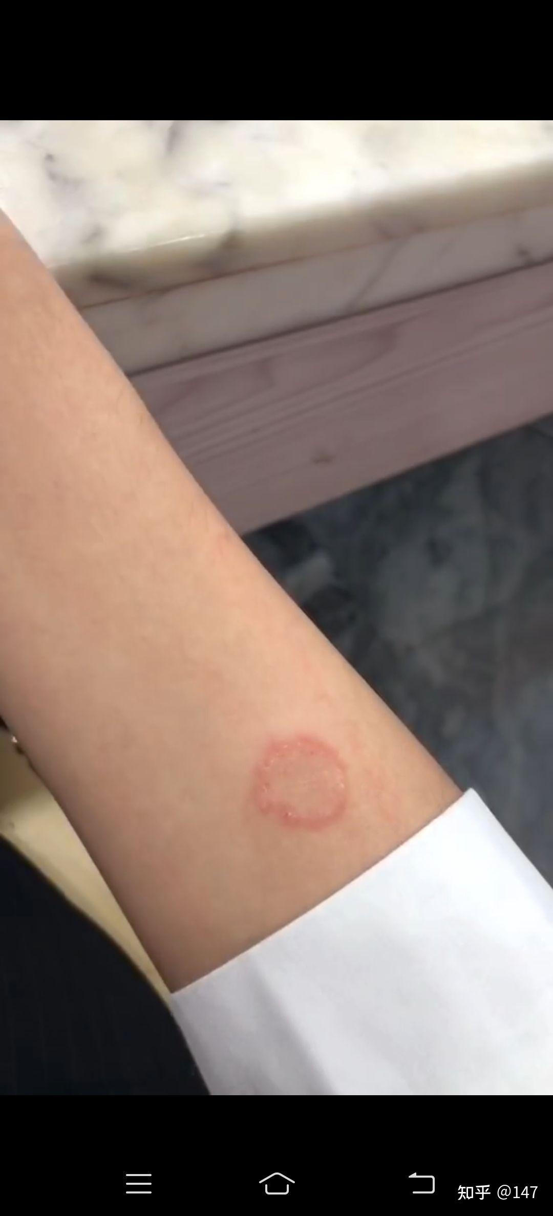 手上本来是一个小圆点,后面变成了这个圆圈是怎么回事? - 知乎