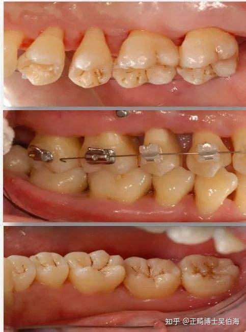 3,正畸治療過程中,每3個月檢查一次牙周狀況,包括牙周袋深度,探診出血