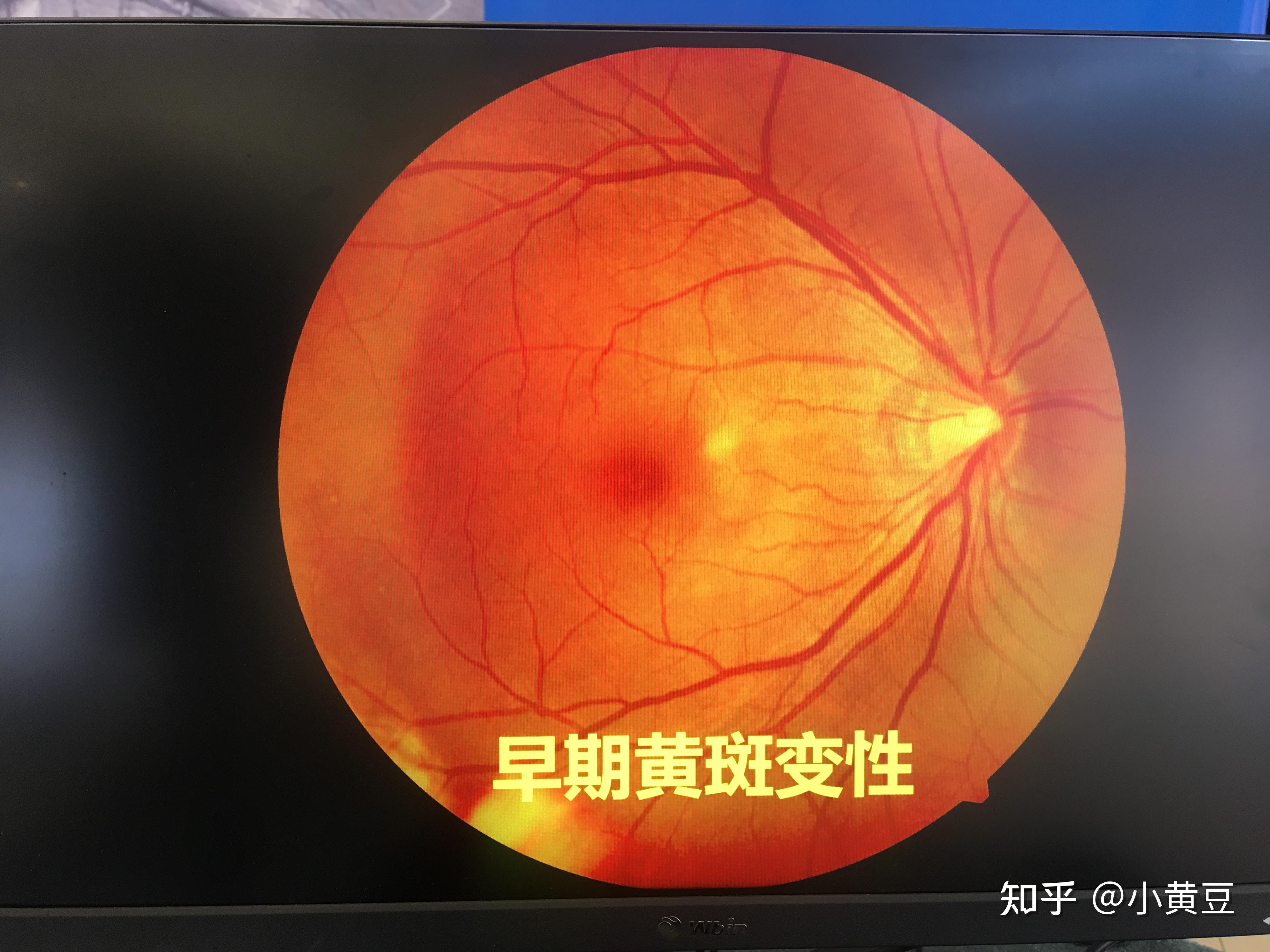 眼充血 有爆炸血管的妇女在眼睛 非常红色bl 库存图片. 图片 包括有 眼皮, 故障, 健康, 爆炸, 传染 - 130856797