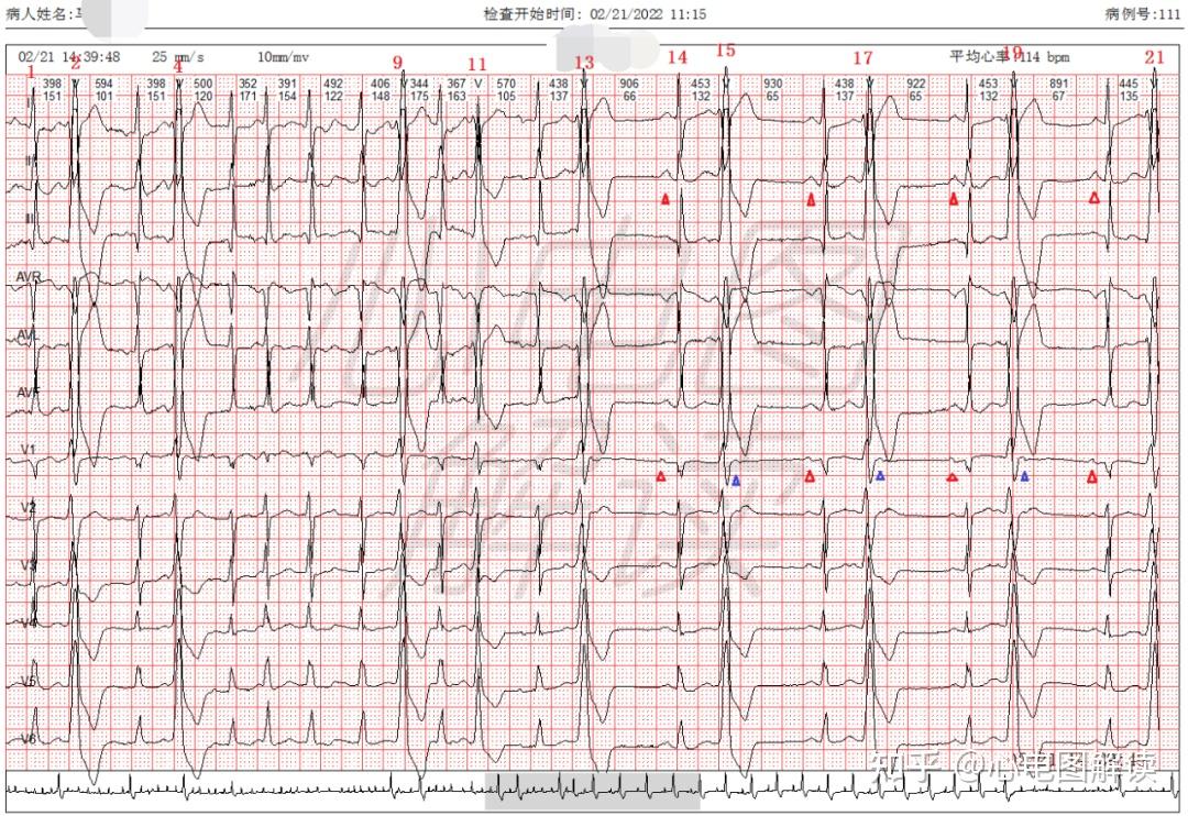 今天要分享的心电图67——阵发性房颤,室早二联律
