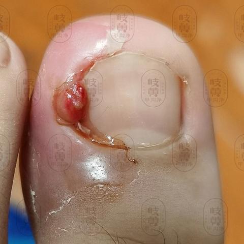 指甲上的美缝甲沟炎有肉芽的时候怎么降肉线,这个办法比矫正神器们好