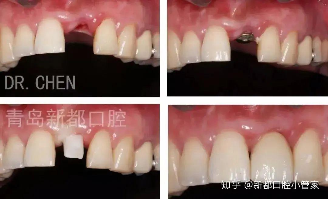 病例:前牙种植氧化锆内冠修复