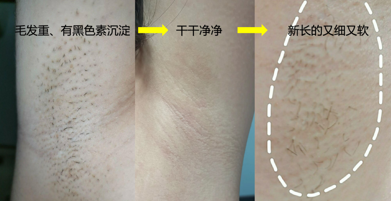在家如何快速脱毛？体毛重怎么抑毛？不用脱毛仪！皮肤科医生教你一套专业【脱毛+抑毛】的方法，无痕无痛不留茬，秒变光滑水煮蛋！