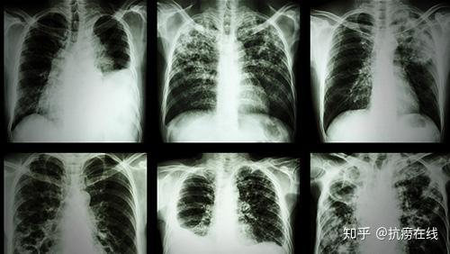 性咳;支气管或纵隔⑤干酪性病变液化或空洞形成时,将液化坏死物质咳出