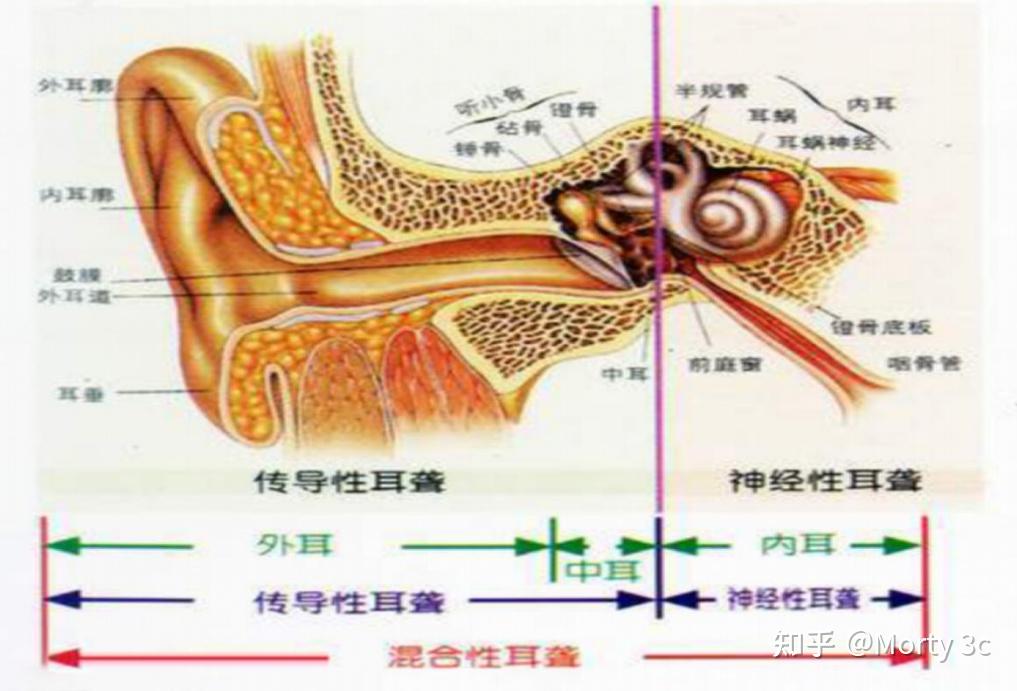听力受损的解决良计——左点耳内式助听器||适用于中度弱听人群 - 知乎