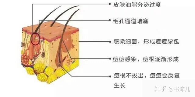 1.遺傳因素影響;2.溼熱的氣候使皮脂腺分泌增加;3.