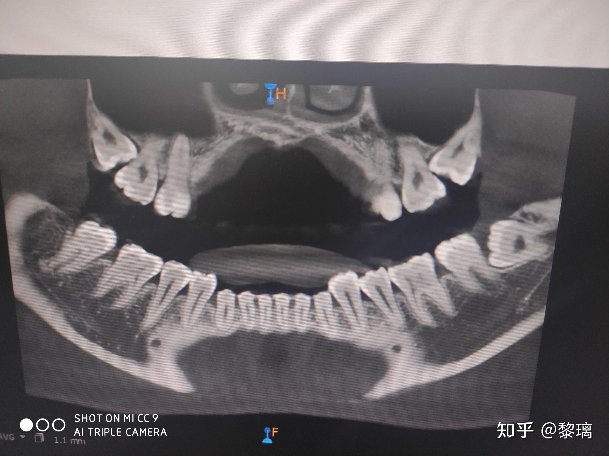 埋伏阻生齿是怎么样的体验? - 知乎