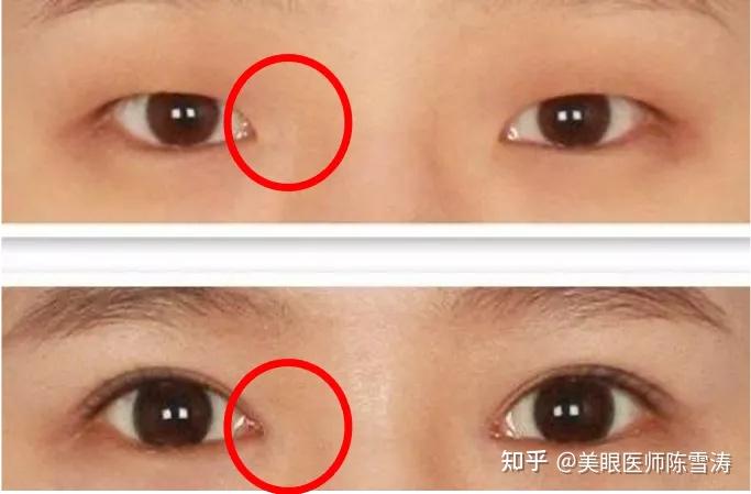 mm合适多少mm不合适,而是要眼部整体的比例,包括要考虑泪阜露出程度