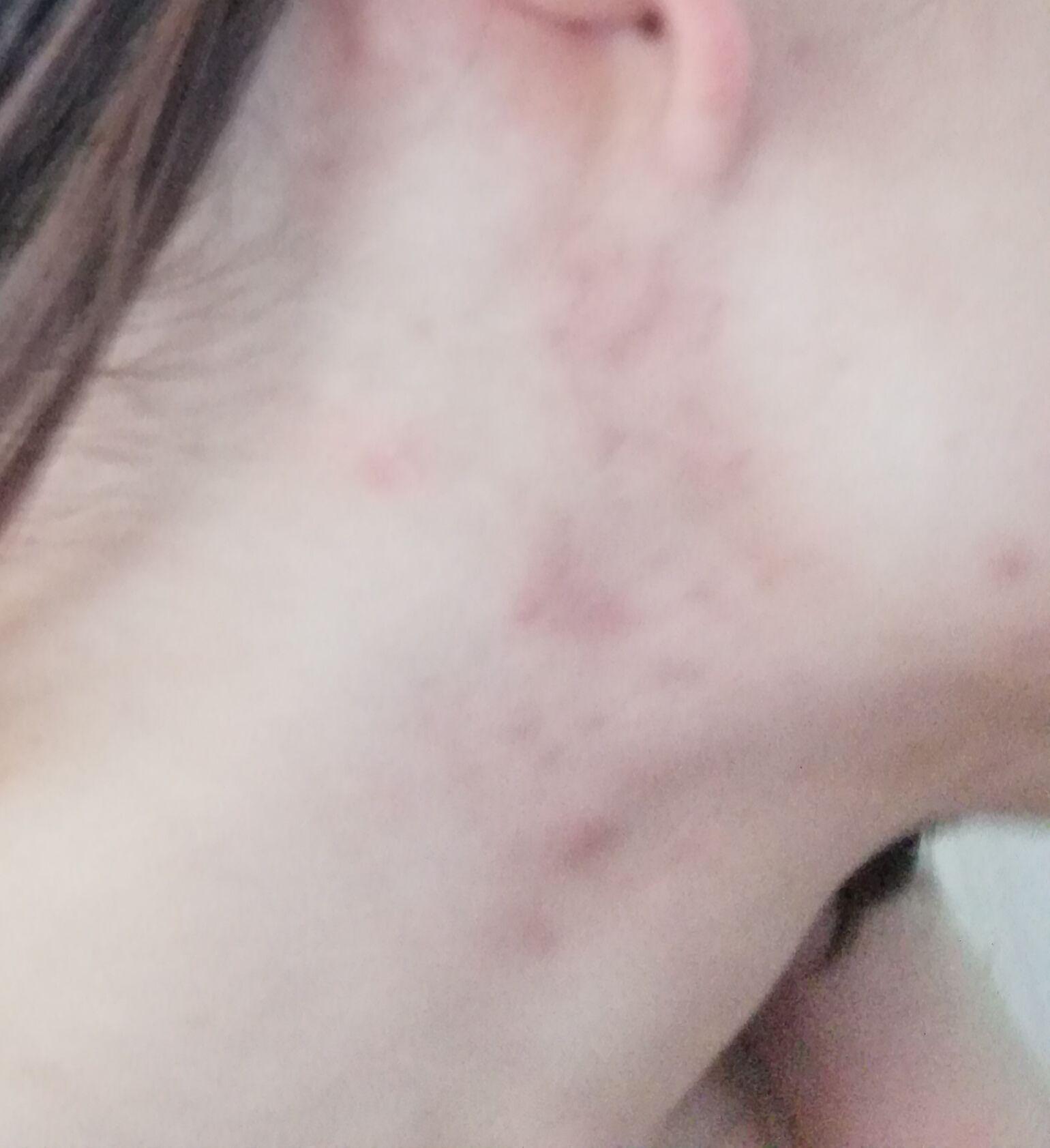 总是两腮长痘是怎么一回事？如何治疗啊