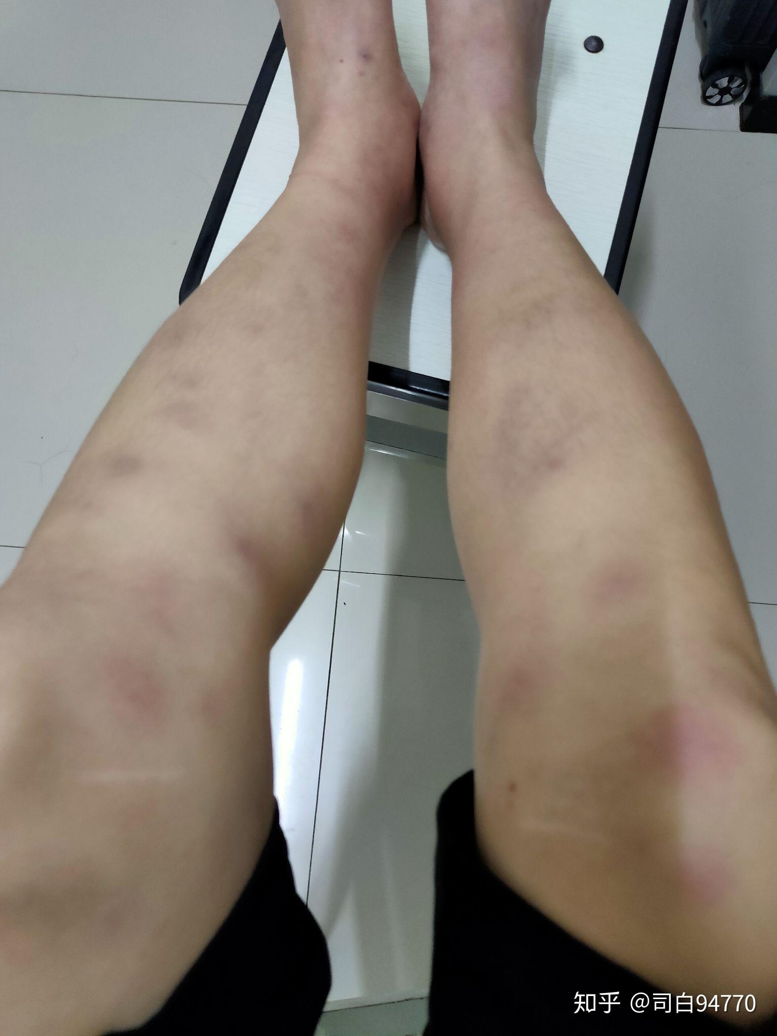 结节性红斑患病历程