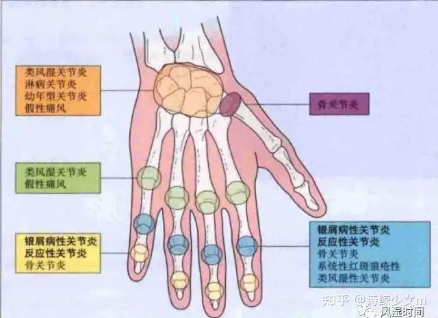 类风湿性关节炎与痛风有哪些区别儿童类风湿性关节炎的原因有哪些