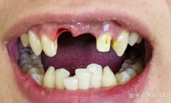 两颗门牙做种植牙的过程经历 - 知乎