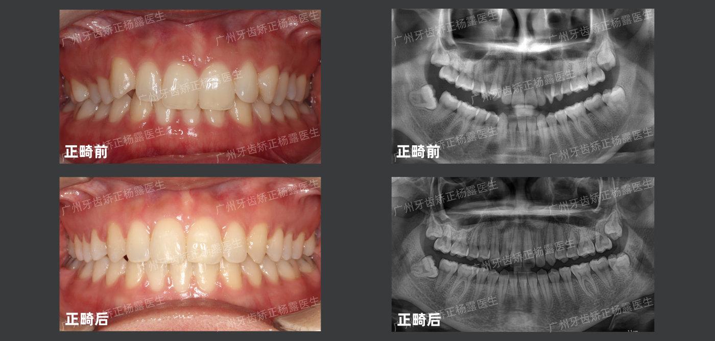 广州牙齿矫正