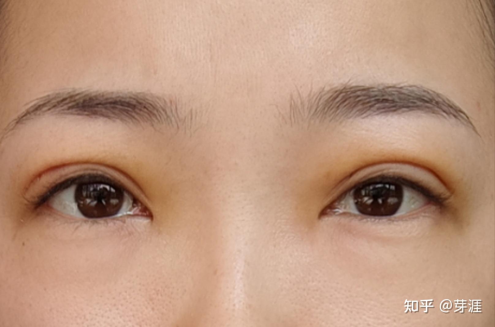 分享下抽脂加埋线双眼皮过程,嘿嘿