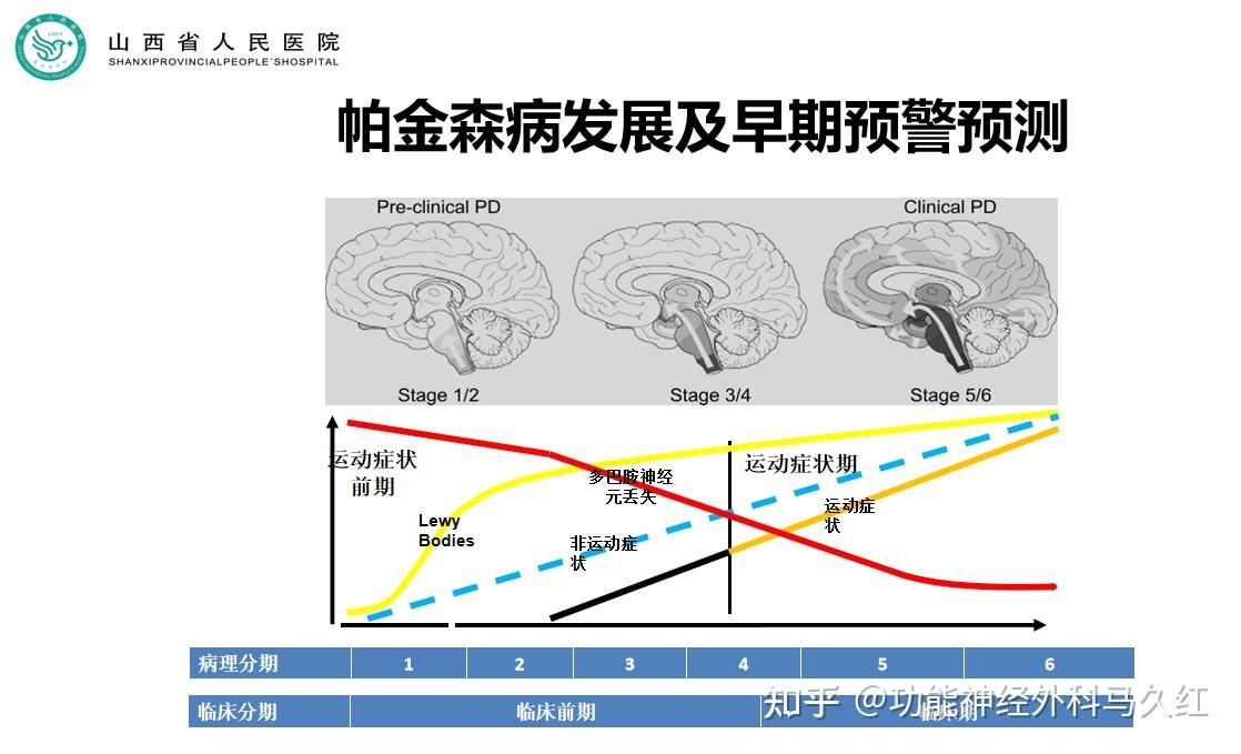 帕金森病 发病率图片