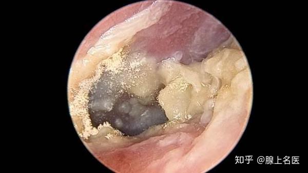 罕见 耳朵里长毛发霉 耳鼻喉专家提醒 这4个习惯不改掉会很惨 知乎