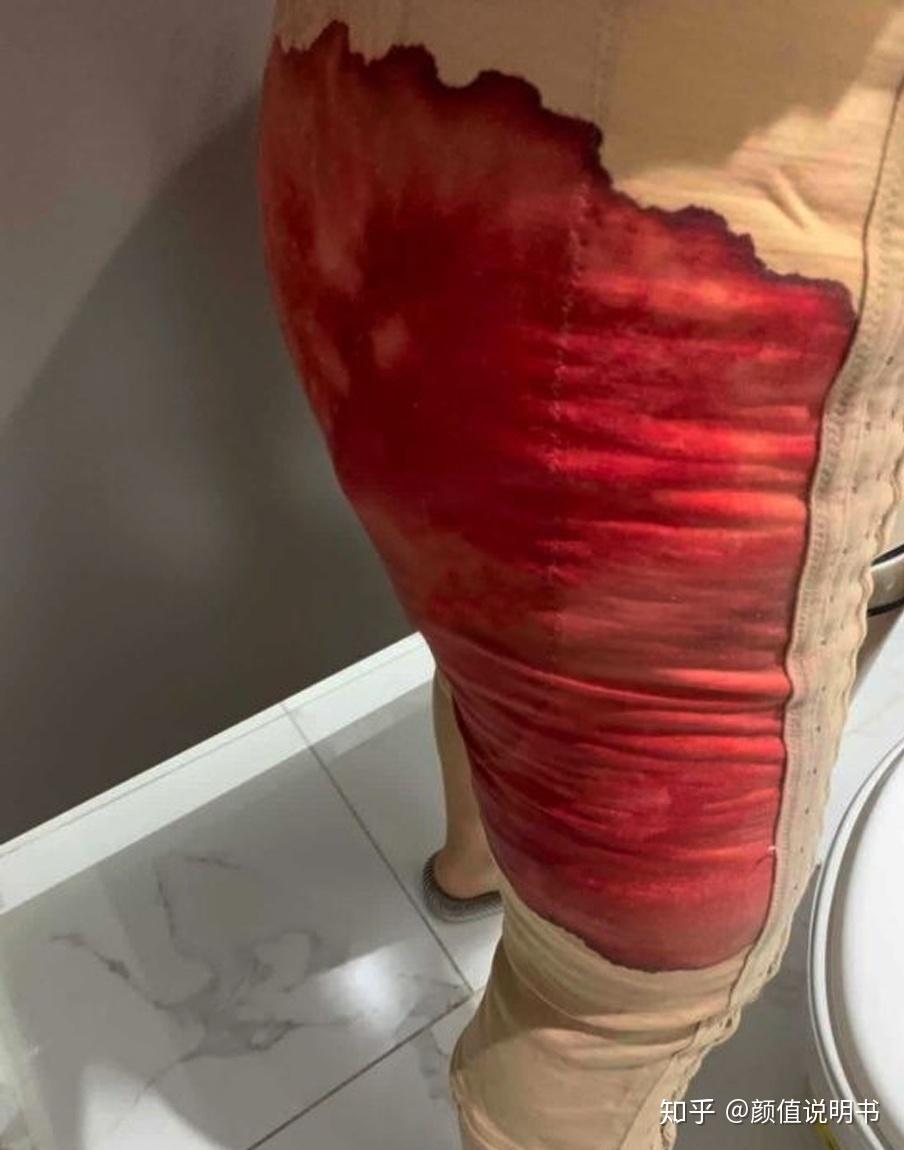 啥叫抽脂手术 v2-ef0b91b0306c97e1759e22ed9dcf9b11_r.jpg