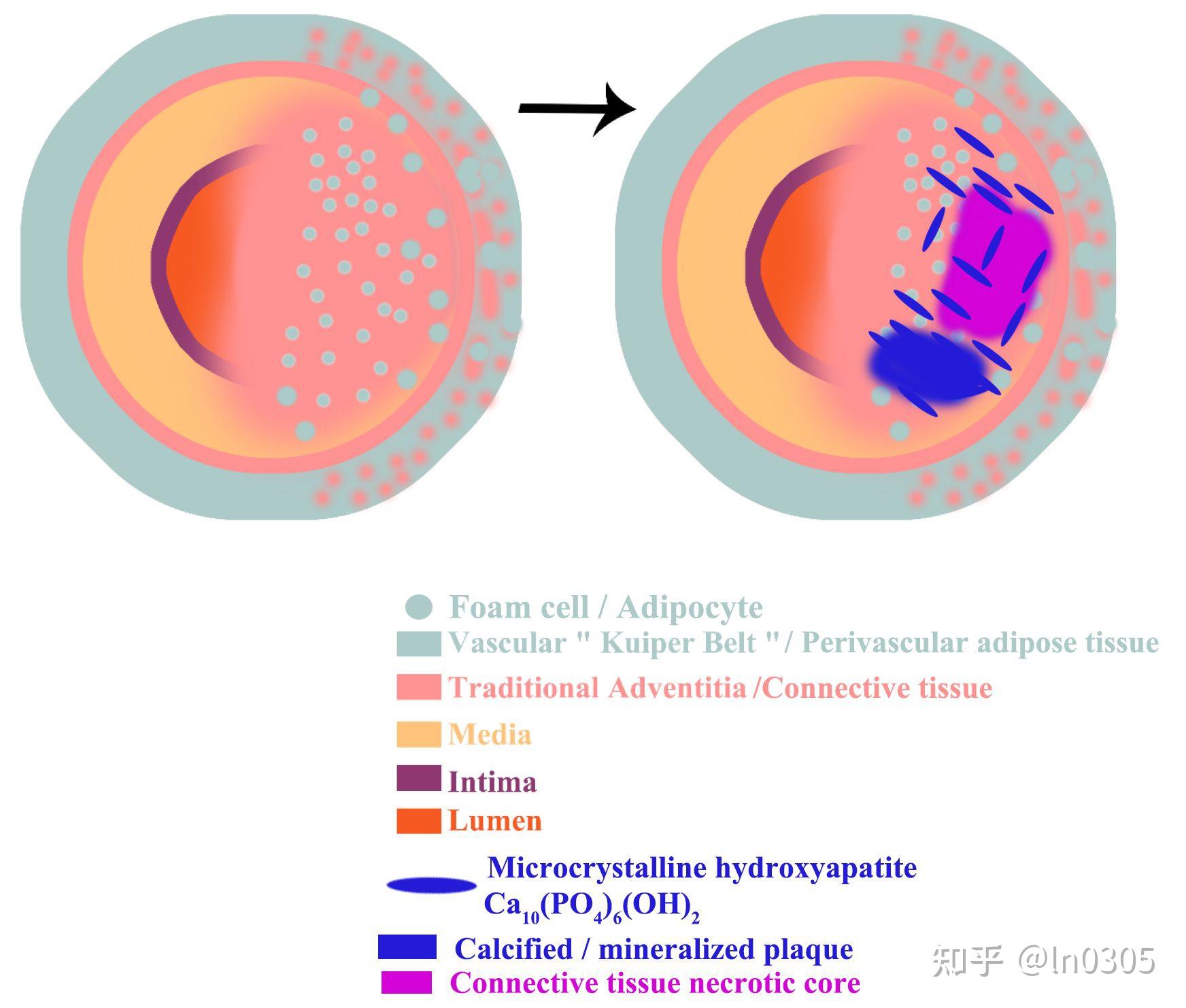 心血管疾病的钙化机制mechanismofcalcificationincardiovascular