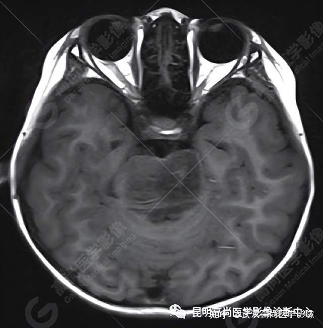脑干弥漫性中线胶质瘤一例「武汉高尚医学影像」
