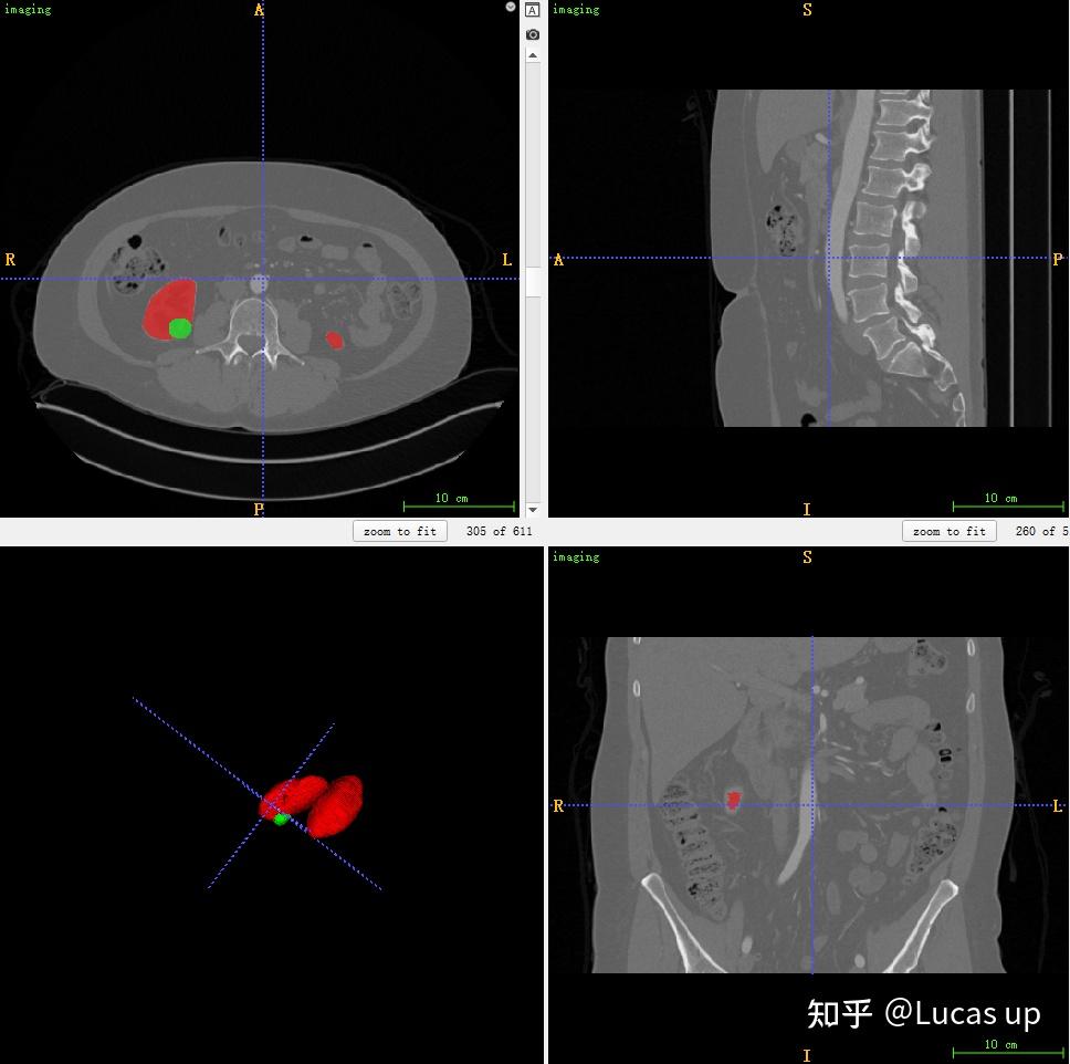 Kits21挑战赛数据获取及处理 知乎
