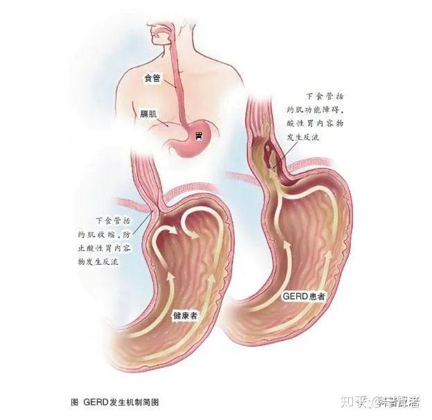 原来是胃食管反流病惹的祸