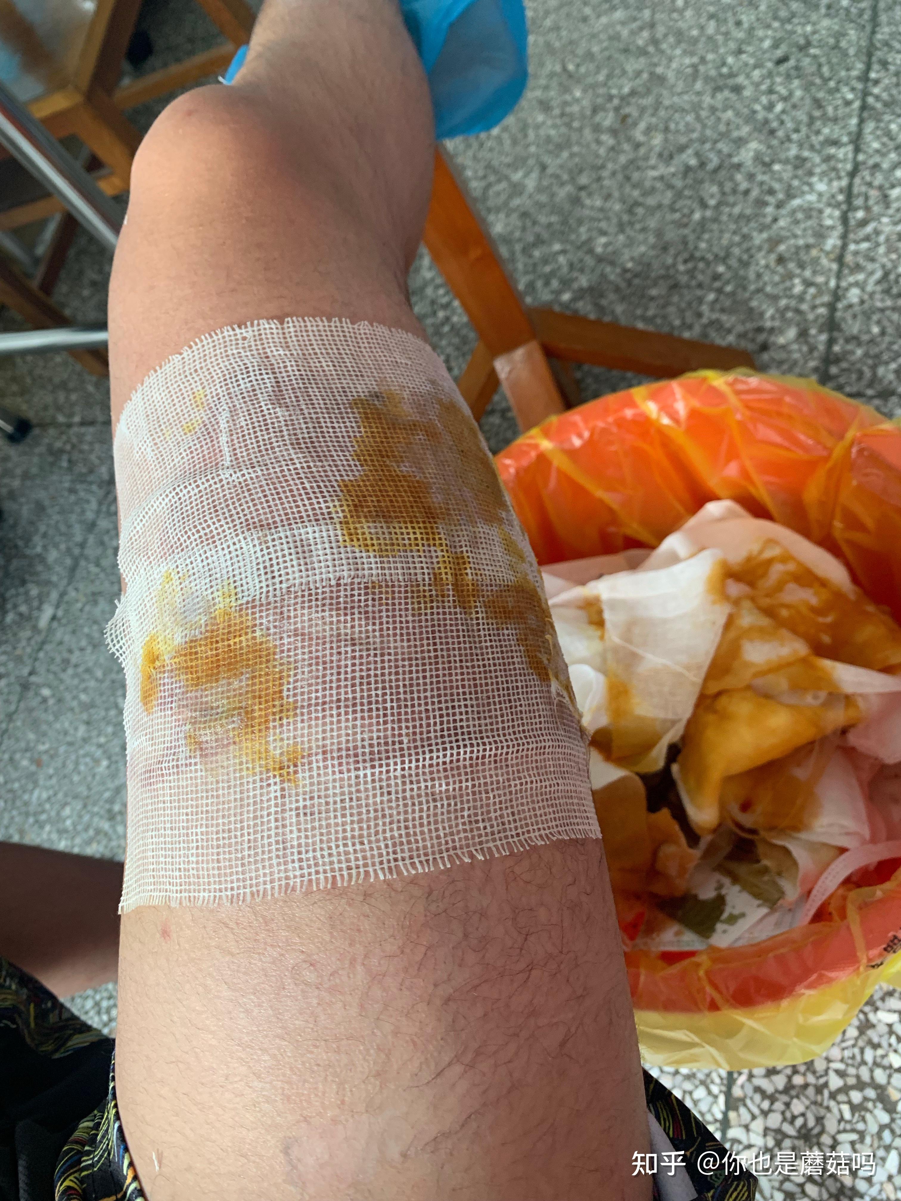 记录开水烫伤的恢复浅二级烧伤