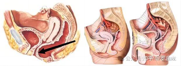 直肠前突的症状图片