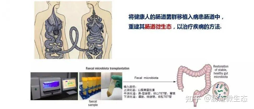 粪便移植虽然听起来略微重口味,但是它作为一项新兴的医疗技术,的确