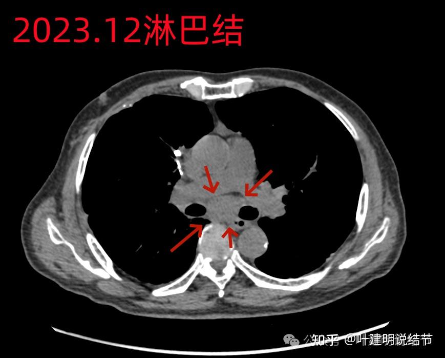 罕見病例剖析微浸潤性腺癌術後1年廣泛轉移