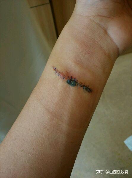 或一层层削薄.会留个很难看的疤,而且价格超级贵.3.割皮祛除纹身拿电