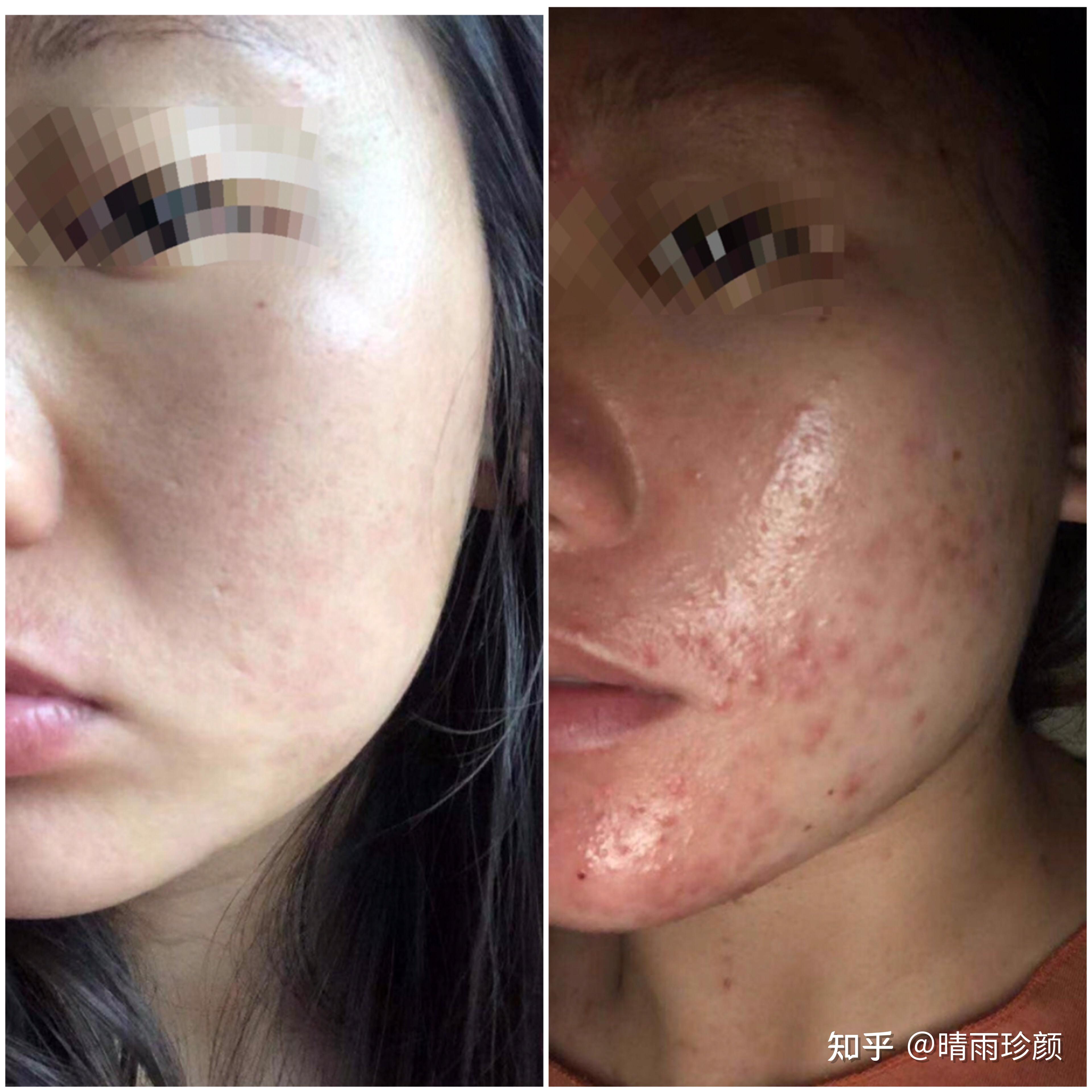 脸上的痘痘痘印怎么样可以去除?