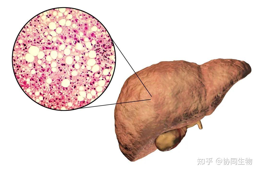 構建非酒精性脂肪肝模型的4種方式! - 知乎