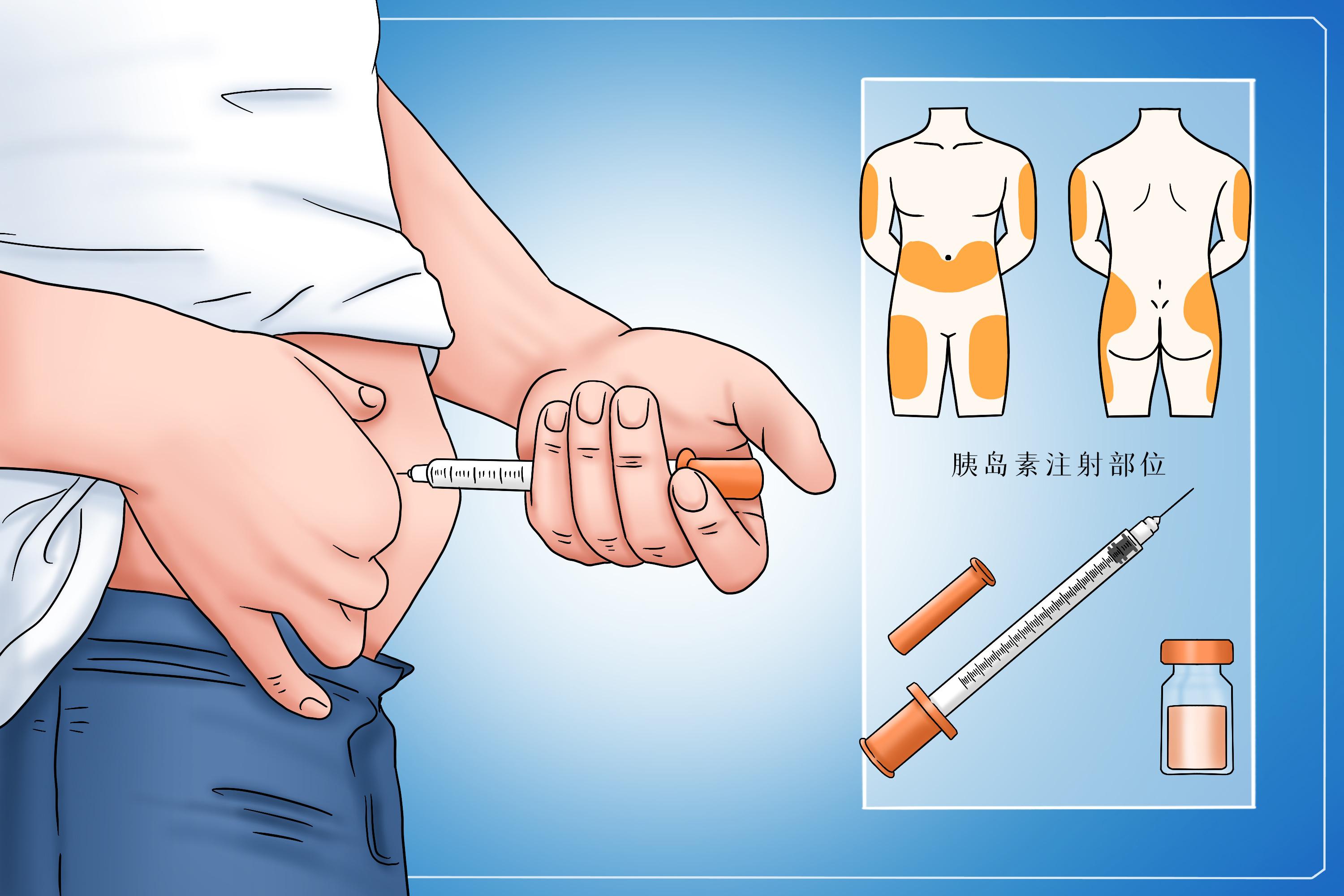 打胰岛素手臂位置图片图片