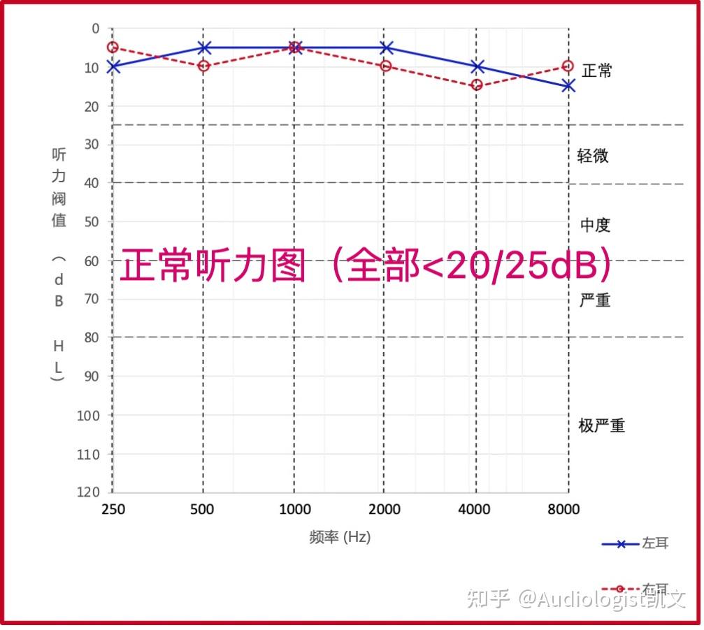 如何看懂听力检查报告！快来看看吧～