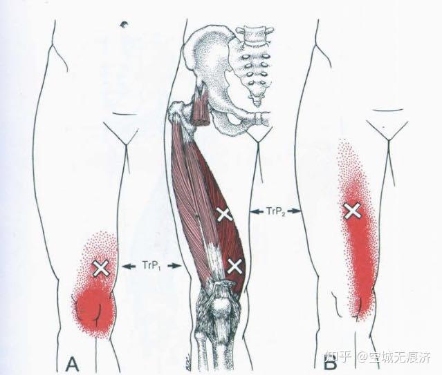 股四头肌肌腱炎位置图片