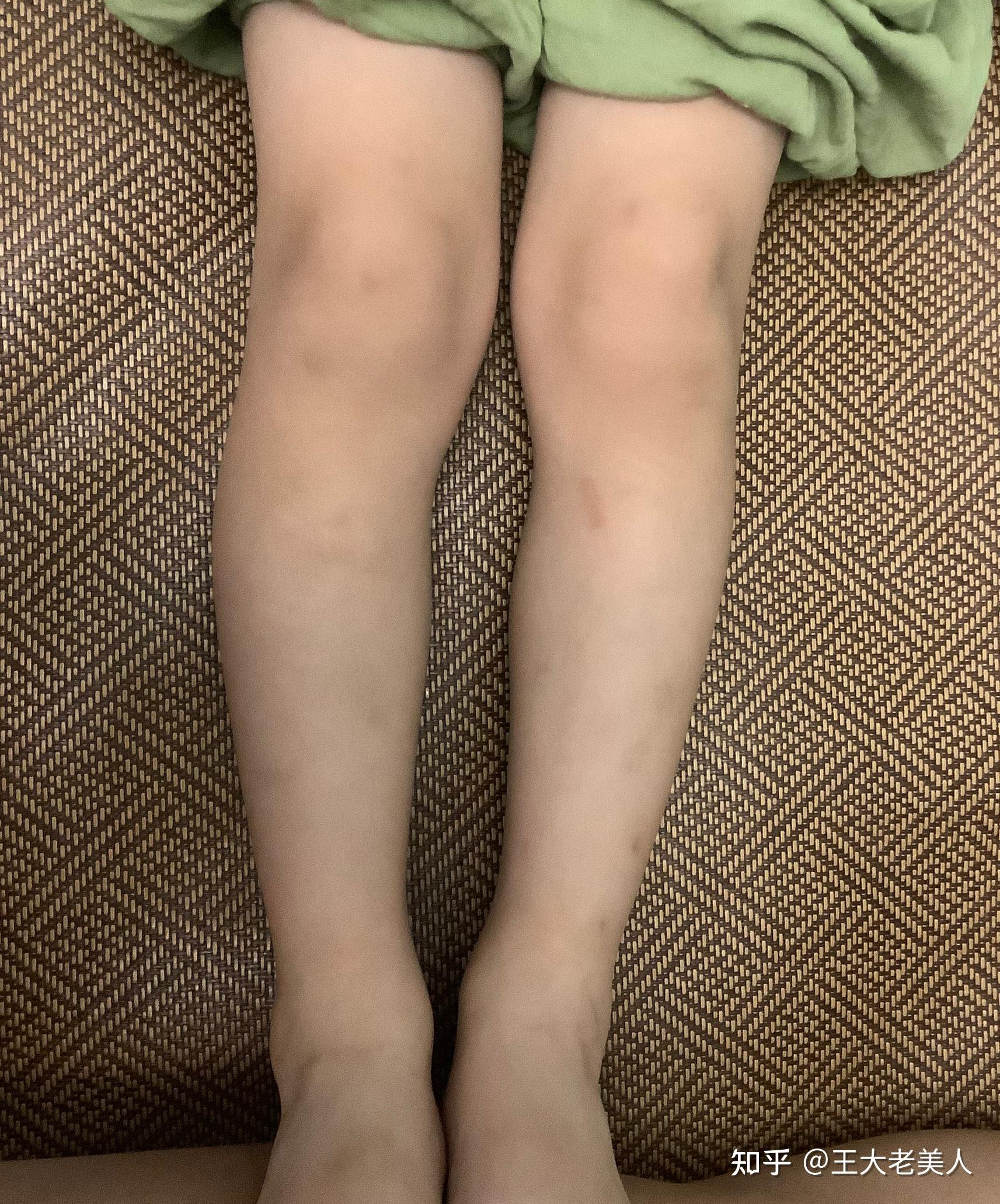 小孩腿弯不正常的图片图片