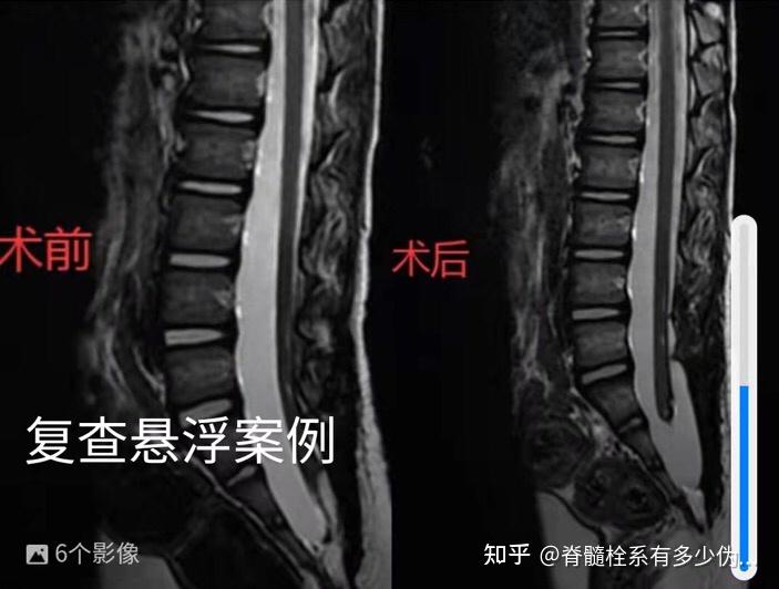 脊髓栓系凹陷图片图片