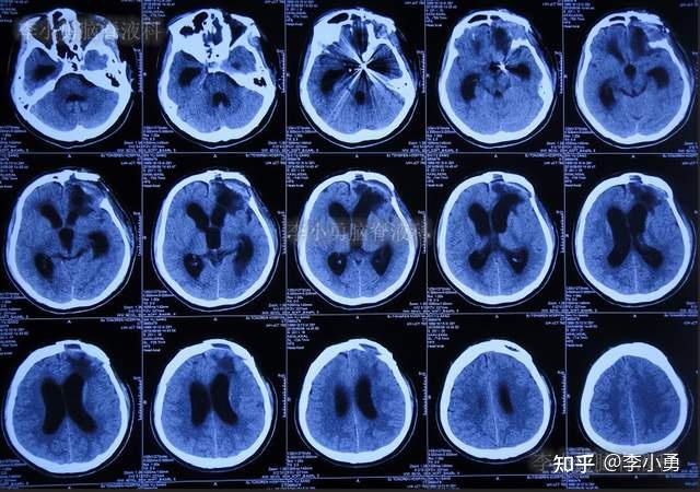 颅内动脉瘤栓塞术后和开颅术脑脊液鼻漏修补术后加重脑积水,且腰大池