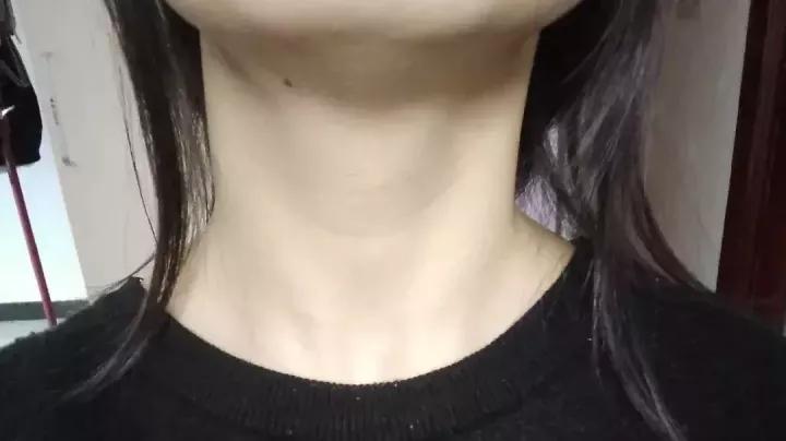 外科体检医生说甲状腺二度肿大,单位要求检查甲功五项和