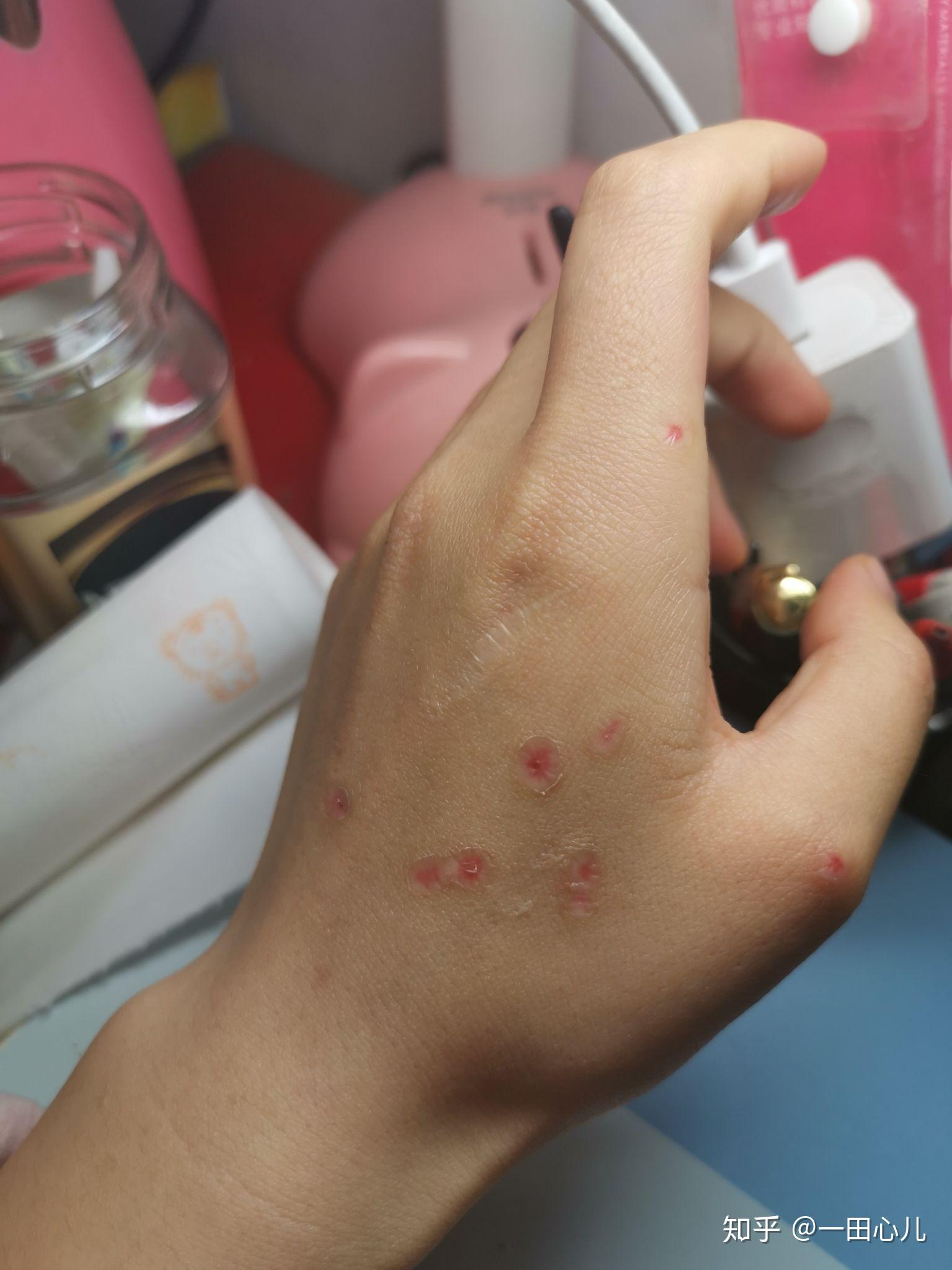 扁平疣冷冻 - 知乎