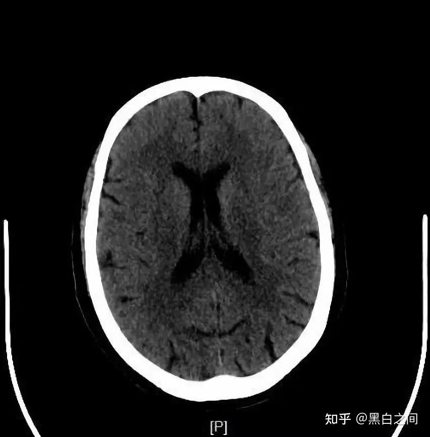脑白质和脑灰质ct图片图片