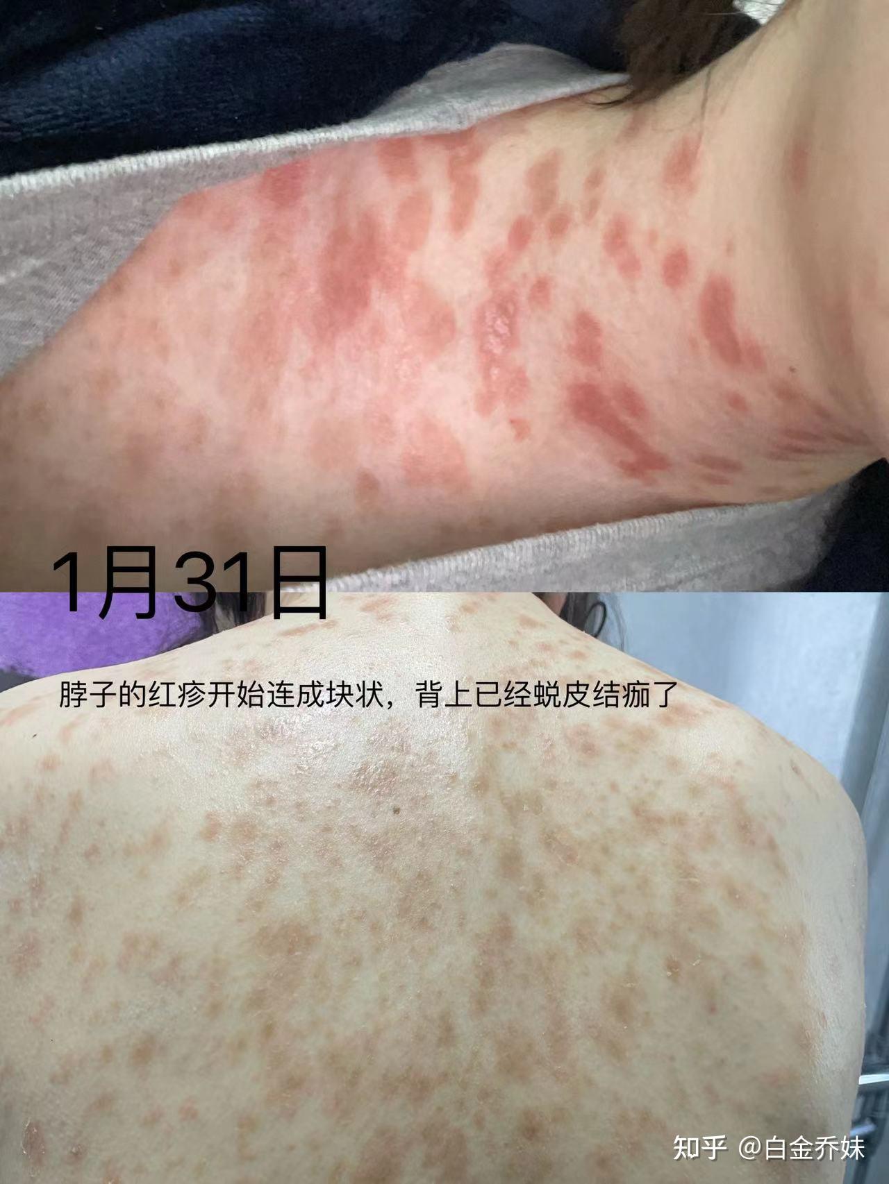 一次关于玫瑰糠疹的记录