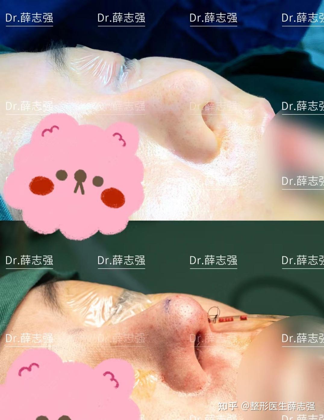 内入路保留鼻整形慢性膨体感染综合鼻修复术后即刻