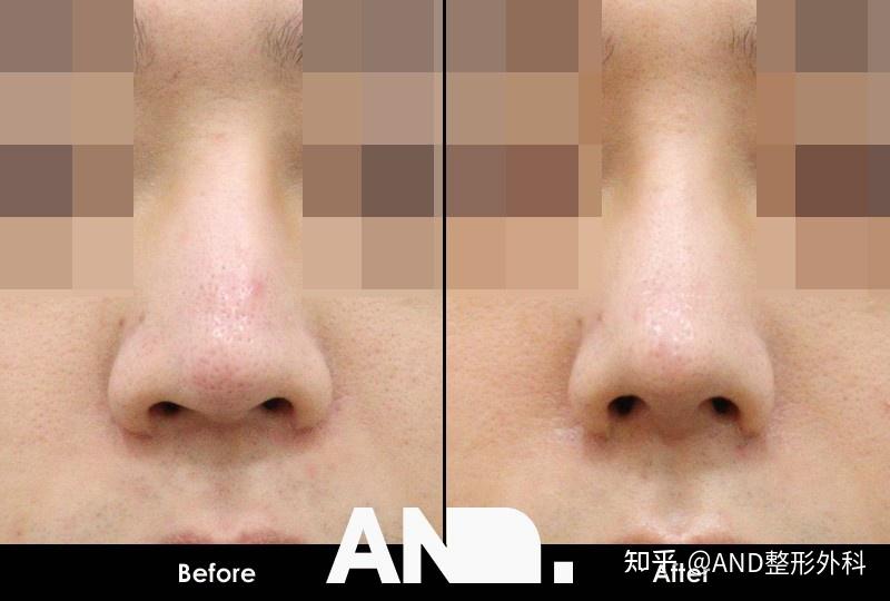 徐康俊鼻部线条:利用3D硅胶矫正歪鼻和轮廓矫正[3D鼻部整形（鼻部再手术_鼻梁+鼻尖）]前后事例 - 知乎