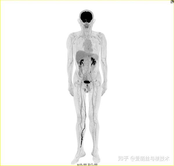全景动态PET-CT成像系统落户仁济医院 2分钟完成全身扫描 - 知乎