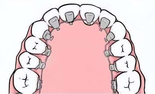 牙齿矫正有哪些矫正方式?区别是什么?正畸有没有什么危害?